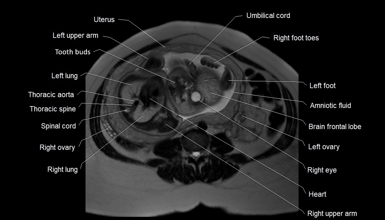 MRI fetal anatomy axial image 15.webp